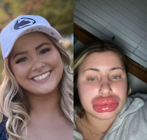 Woman's Lips Swells After Allergic Reaction To Fillers