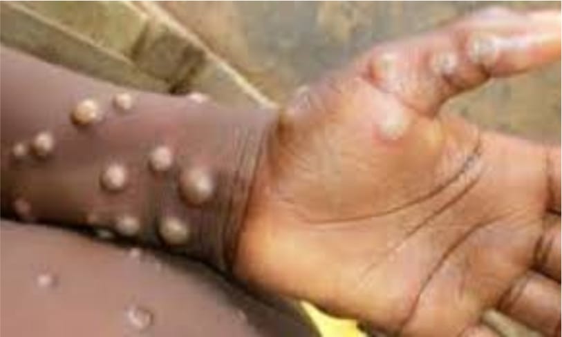 Abia State Confirms First Monkeypox Case